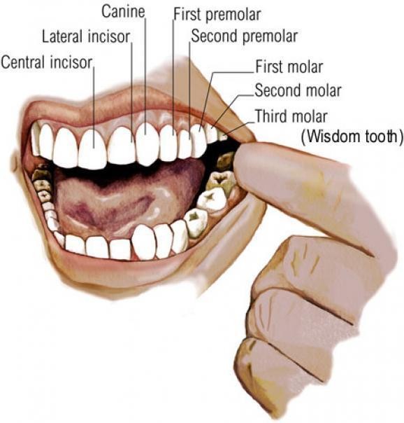 Wisdom-tooth