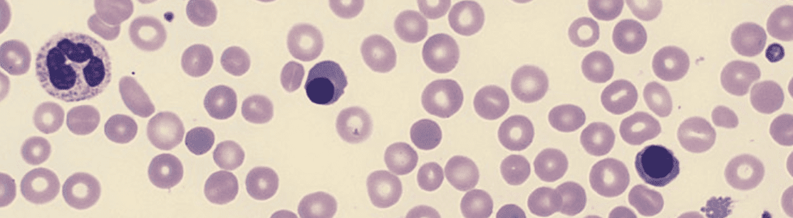 الكريات_الحمراء_المنواه__NRBC__nucleated_red_blood_cells-2