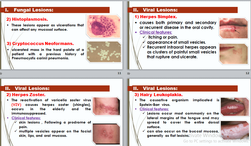 عرض تقديمي عن (أعراض الإيدز في الفم) 2 (Power-point)