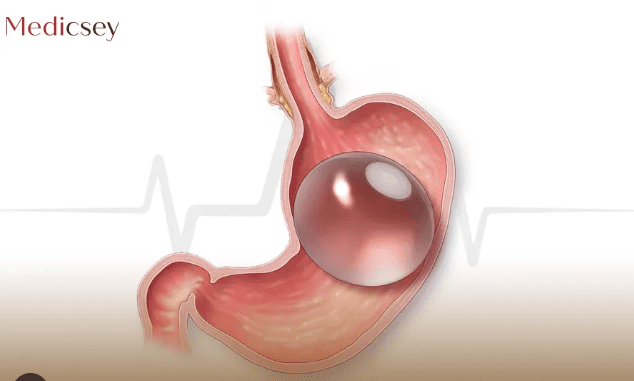 تكلفة عملية بالون المعدة في تركيا | مديكسي M