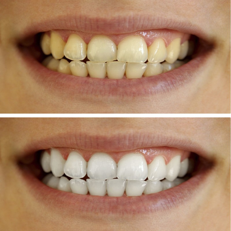 إصفرار-الأسنان.png-2