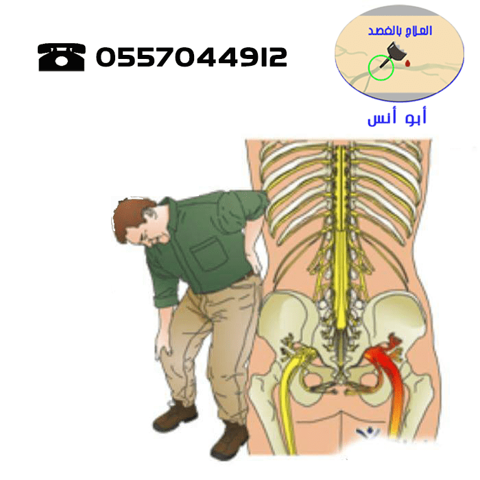 ابو انس لعلاج عرق النسا بالفصد فى الرياض 0557044912 L