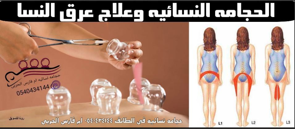 الحجامه_النسائيه_وعرق_النسا
