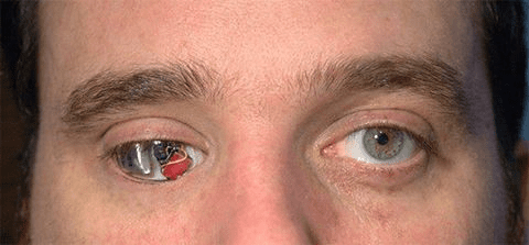 مخرج بعين صناعية