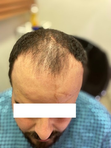 عملية زراعة الشعر د.علاء حجاج S