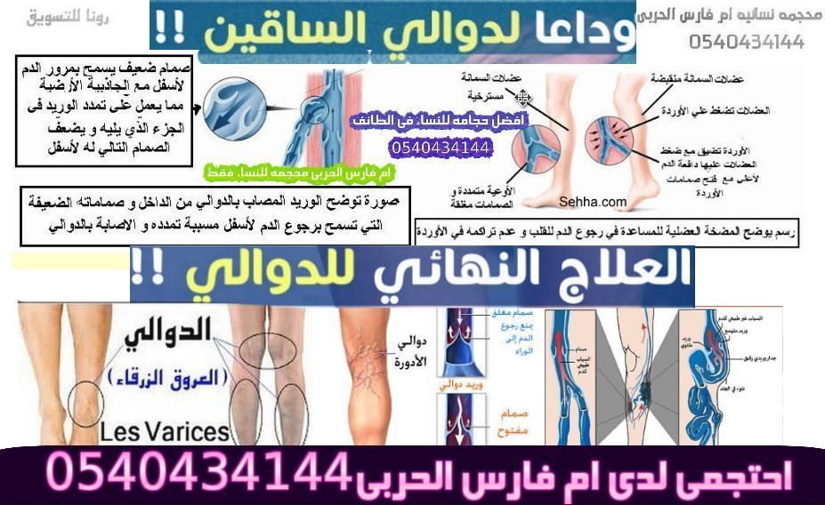 الحجامه_وعلاج_دوالى_الساقين