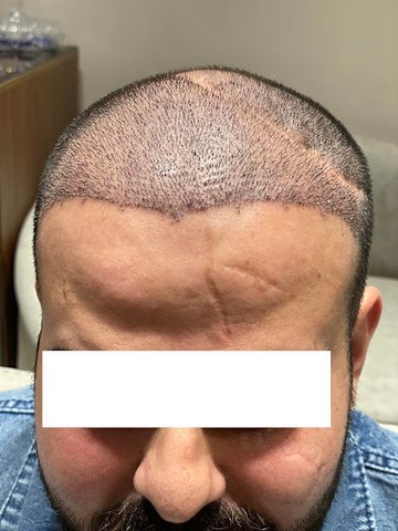 عملية زراعة الشعر د.علاء حجاج S